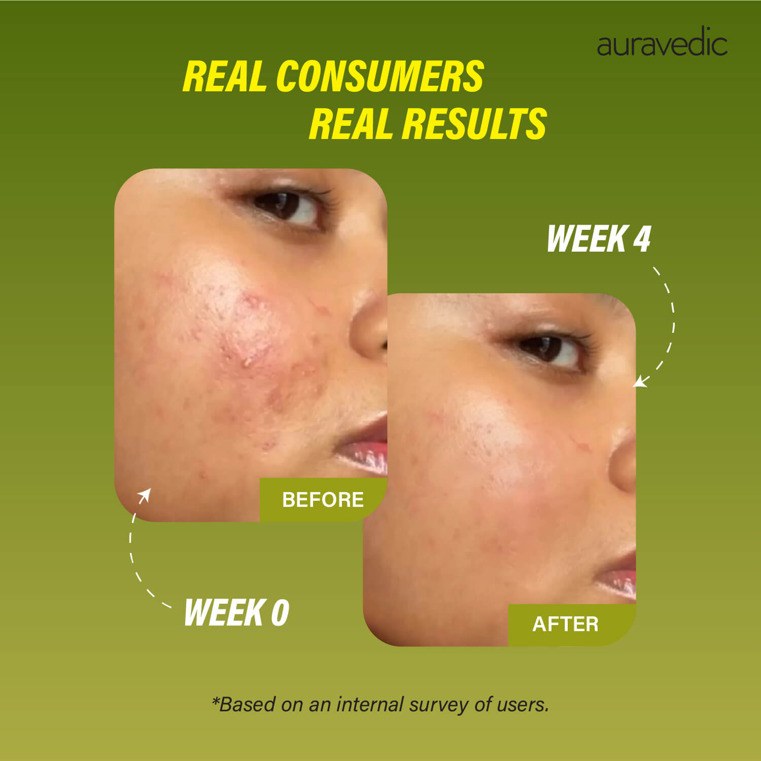 Acne Free in 3 Steps